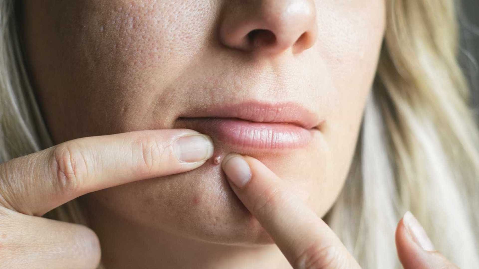4 passos para se livrar rápido de uma espinha dolorida e inchada