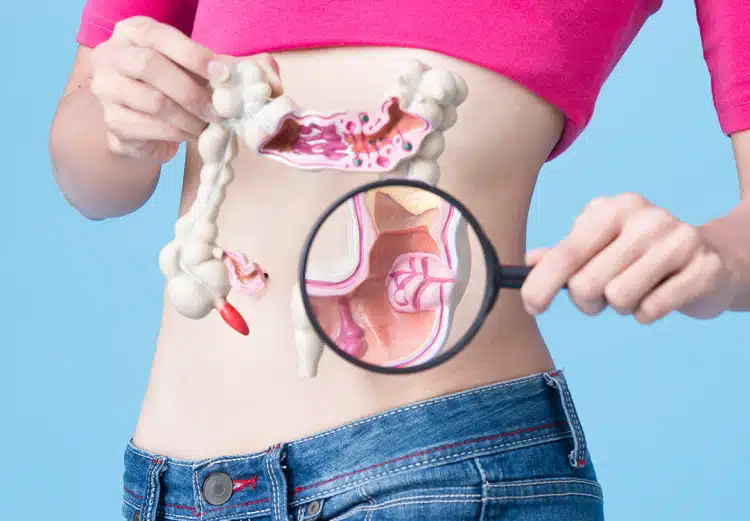 Mitos e verdades do câncer de intestino